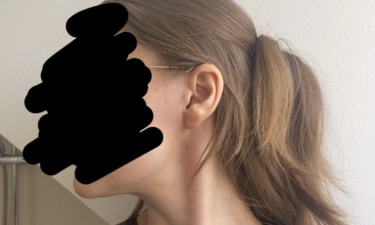 Má pro mě smysl lipolýza podbradku, nebo je nutno problém řešit jinak? - 84473