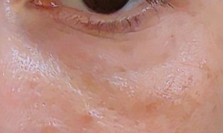 Horni a dolni vicka s transferem tuku - 84497