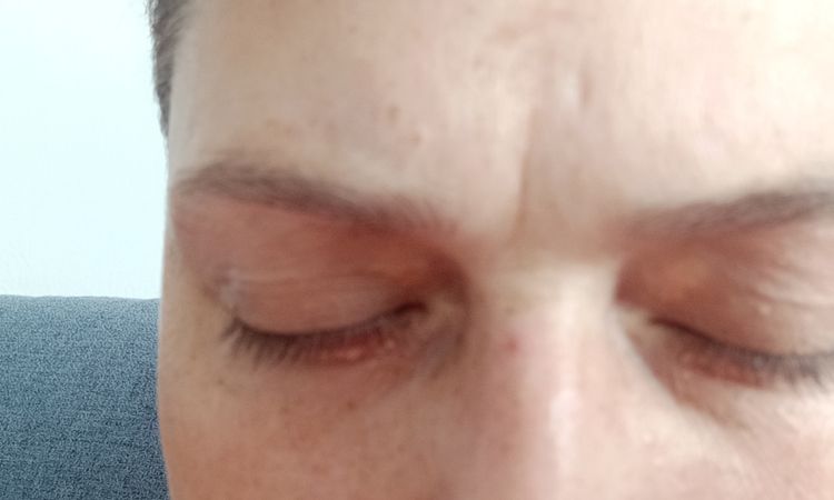 Odstranění xantelasma - 84594