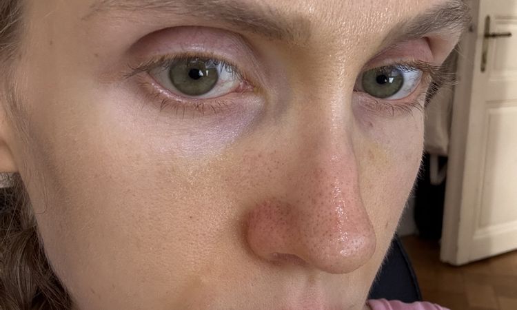 Jazva a vychýlena kosť po rhinoplastike - 84669