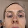 Jazva a vychýlena kosť po rhinoplastike
