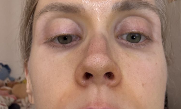 Jazva a vychýlena kosť po rhinoplastike - 84670