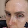 Jazva a vychýlena kosť po rhinoplastike