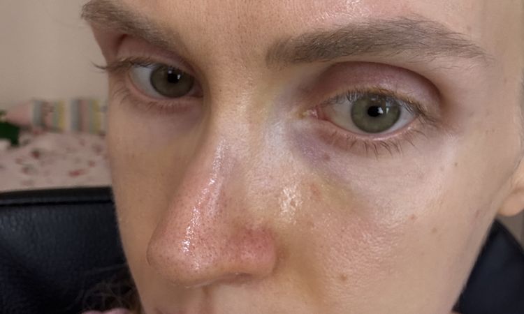 Jazva a vychýlena kosť po rhinoplastike - 84671