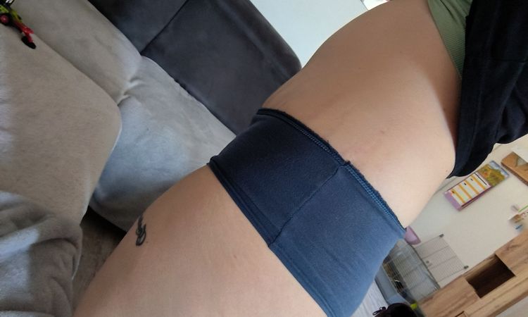 Abdominoplastika a znovu kýla - 84932