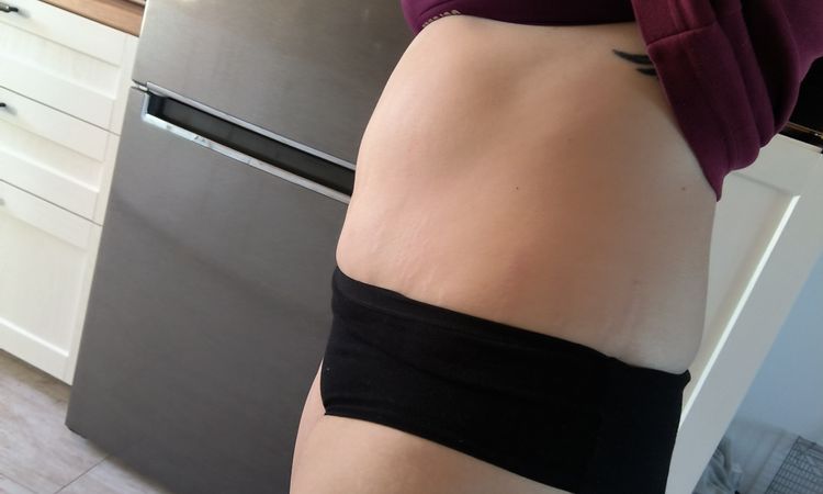 Abdominoplastika a znovu kýla - 84933
