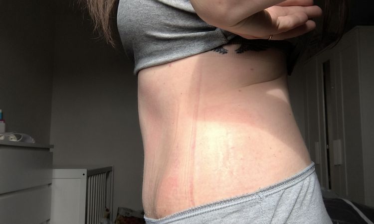 Abdominoplastika a znovu kýla - 84934
