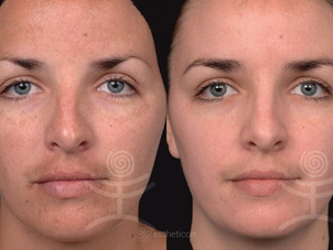 Výsledek chemického peelingu