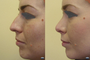 Před/po rhinoplastika