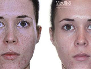 Výsledek chemického peelingu