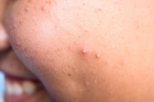 Léčba akné - příčiny vzniku