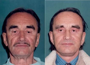 Fotky před a po faceliftu (foto: soukromý archiv lékaře)