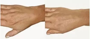 Omlazení hřebtů ruky. Fotky před a po mezoterapii. (foto: soukromý archiv kliniky)