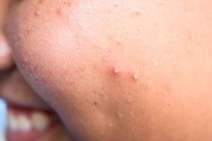 Jak na jizvy po akné - masti a krémy