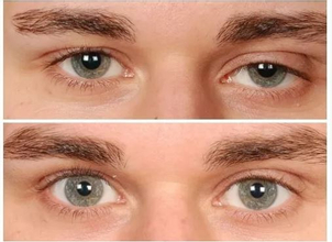 Muž, 26 let, ptóza. Foto: Před operací a 1 rok po operaci (shora)