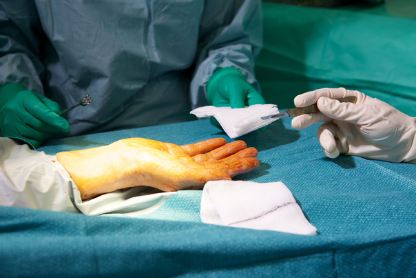 Jak se provádí chirurgie ruky?