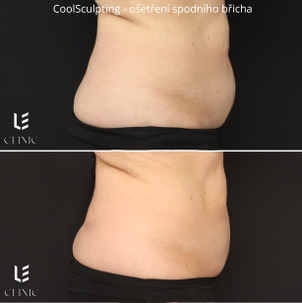 Výsledek kryolipolýzy