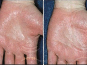 Před a po ošetření nadměrného pocení