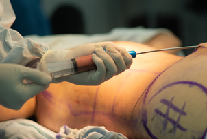 Techniky liposukce
