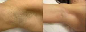 Laserová epilace podpaží. Foto před a po epilací (soukromí archiv kliniky)