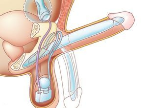 Jak funguje erektilní protéza