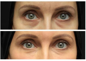 Kyselina hyaluronová