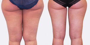 Před/po laserová liposukce