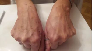 Fotka po aplikaci mezonití, porovnání vlevo před ošetřením, vpravo po ošetření (foto: sourkomý archiv lékaře)