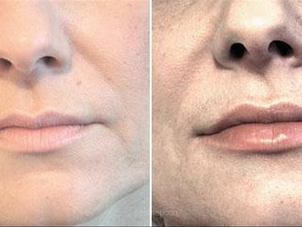 Před zákrokem lip lift