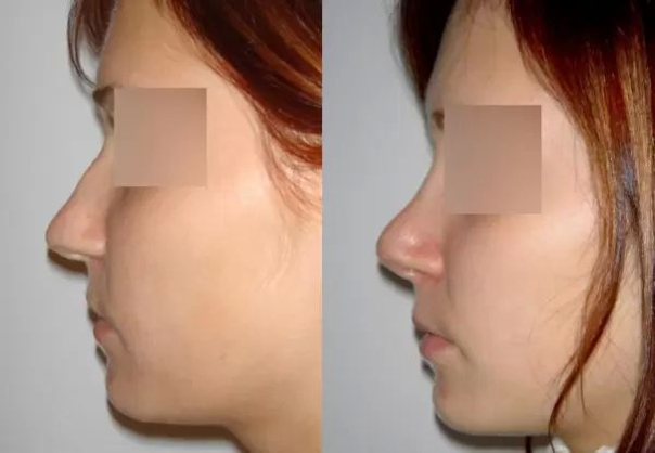 Před/po plastická operace nosu (rhinoplastika)