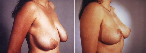 Modelace prsou - před/po