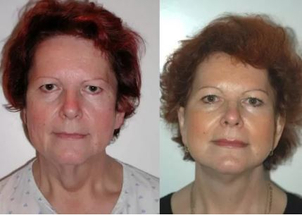 Fotky před a po faceliftu obličeje. (foto: soukromý archiv lékaře)