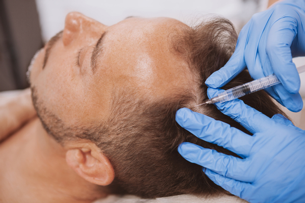 Jak probíhá zotavení po léčbě vypadávání vlasů pomocí plazmaterapie?