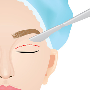 Plastika očních víček