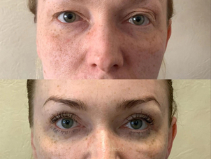 Výsledek laserové blefaroplastiky