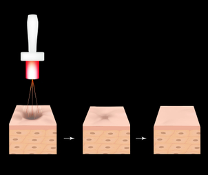 odstranění jizev laserem