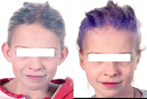 Před/po: otoplastika