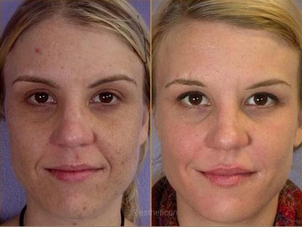 Výsledek chemického peelingu