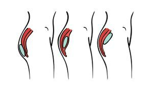 Zvětšení hýždí implantátem