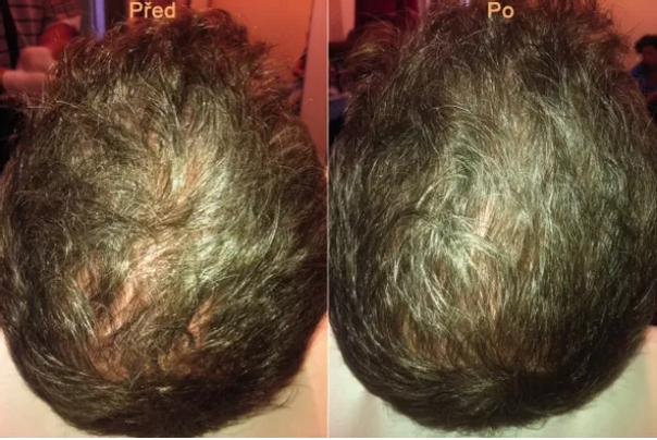 Co je léčba vypadávání vlasů pomocí plazmaterapie?