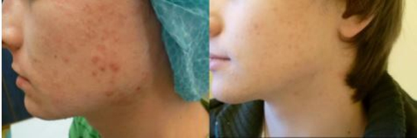 Fotky před a po léčbě akné laserem. (Foto: Soukromý archiv kliniky)