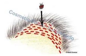 Transplantát ve formě minisazenice