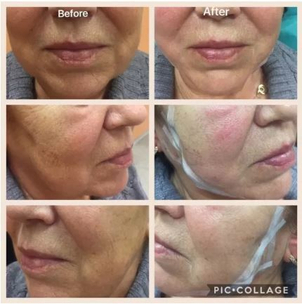 Fotky před a po niťovém liftingu (foto: soukromý archiv lékaře)