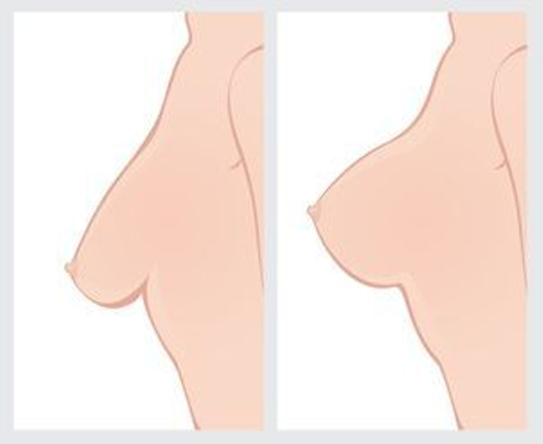 Indikace k modelaci prsou spojené s augmentací