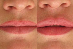 Výplň rtů kyselinou hyaluronovou