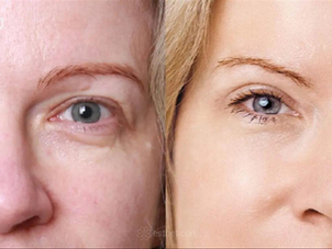 Výsledek laserové blefaroplastiky