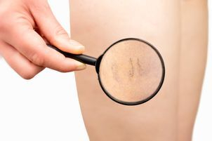 Proč přistoupit k léčbě křečových žil?