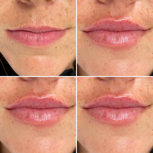 Před a po aplikací injekčních výplní