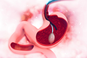 Komplikace nebo možné vedlejší účinky