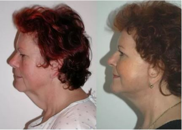 Fotky před a po faceliftu z profilu (foto: soukromý archiv lékaře)